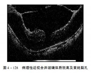 玻璃体变性